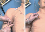 Bilateral Sites for Chest Tube Insertion and Pneumothorax relief